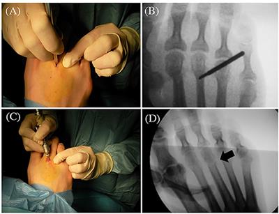 Influence of Foot Type on the Clinical Outcome of Minimally Invasive Surgery for Metatarsalgia. A Prospective Pilot Study